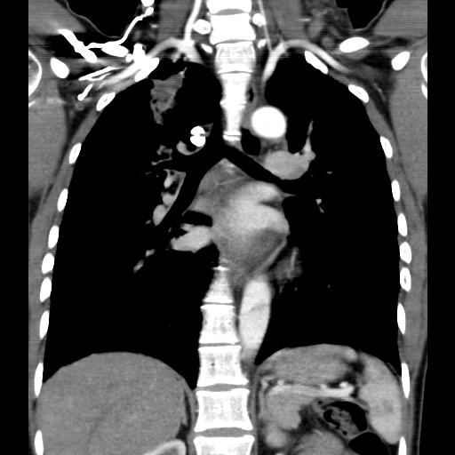 File:Non-small cell lung cancer with miliary metastases (Radiopaedia 23995-24193 B 11).jpg