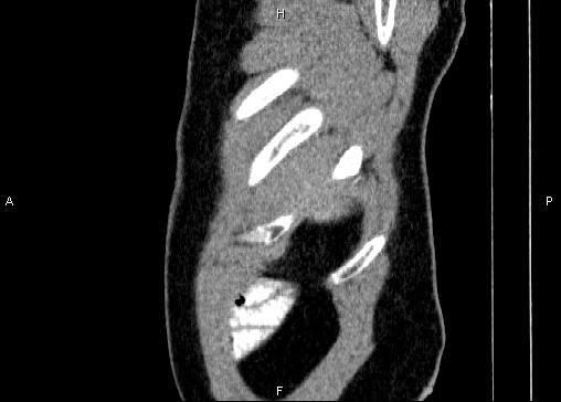 Non-syndromic pancreatic endocrine tumor (Radiopaedia 86958-103178 E 4).jpg