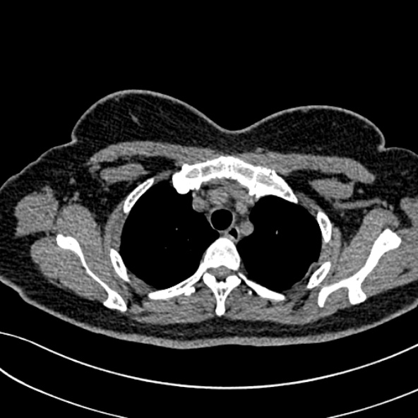 Normal CT chest- adult female (Radiopaedia 52522-58428 Axial non-contrast 30).jpg