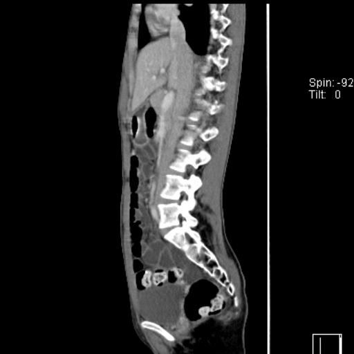 Normal CT enterography (Radiopaedia 30357-31000 D 31).jpg