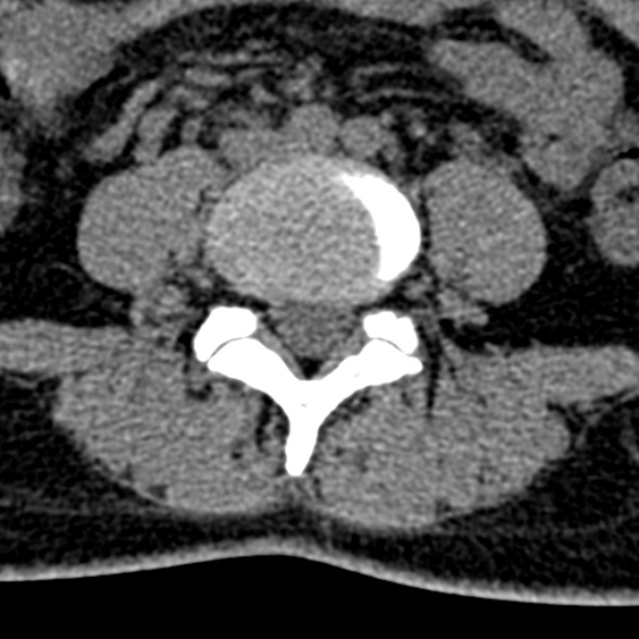 Normal CT lumbar spine (Radiopaedia 53981-60118 Axial non-contrast 70).jpg