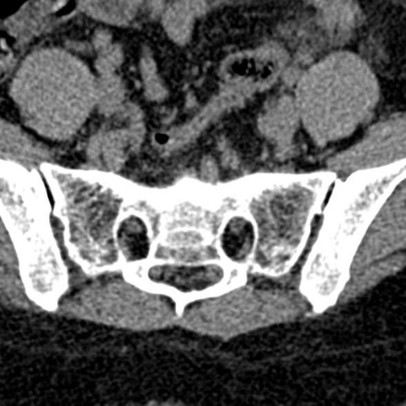 Normal CT lumbar spine (Radiopaedia 53981-60118 Axial non-contrast 97).jpg