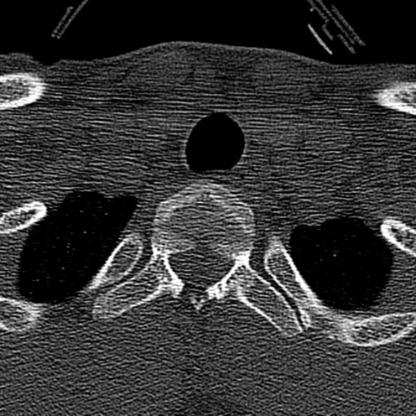 Normal CT of the cervical spine (Radiopaedia 53322-59305 Axial bone window 251).jpg