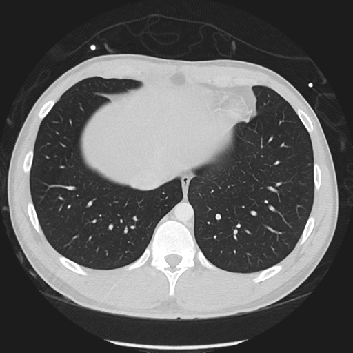 Normal CT pulmonary veins (pre RF ablation) (Radiopaedia 41748-44702 Axial lung window 52).png