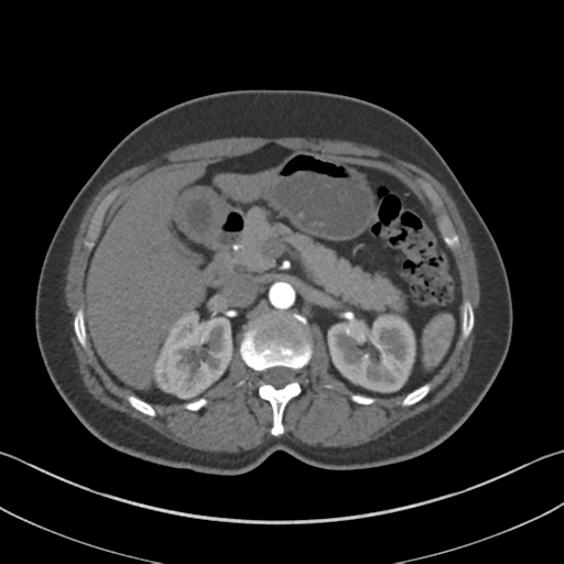 File:Normal CT renal artery angiogram (Radiopaedia 38727-40889 A 34).png
