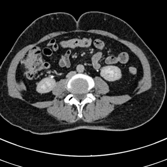 File:Normal CT split bolus study of the renal tract (Radiopaedia 48631-53634 Axial split bolus 146).jpg