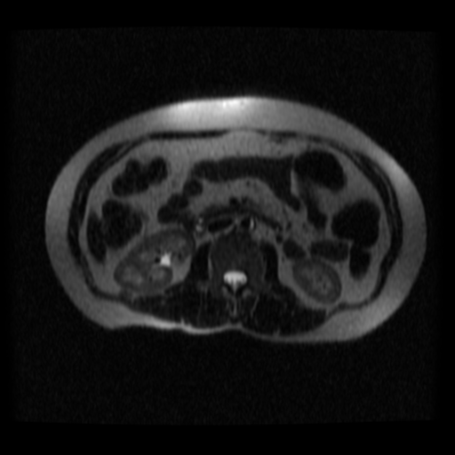 File:Normal MRCP (Radiopaedia 41966-44978 Axial T2 thins 4).png