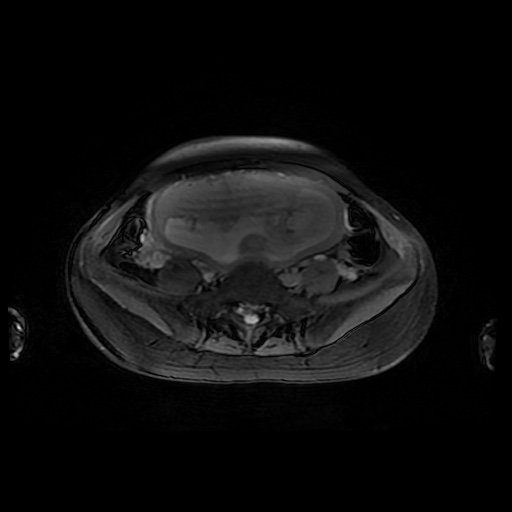 File:Normal MRI abdomen in pregnancy (Radiopaedia 88001-104541 D 38).jpg