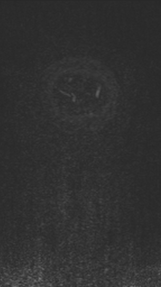 Normal MRI brain with MRV- teenager (Radiopaedia 49425-54553 Coronal MRV 225).jpg