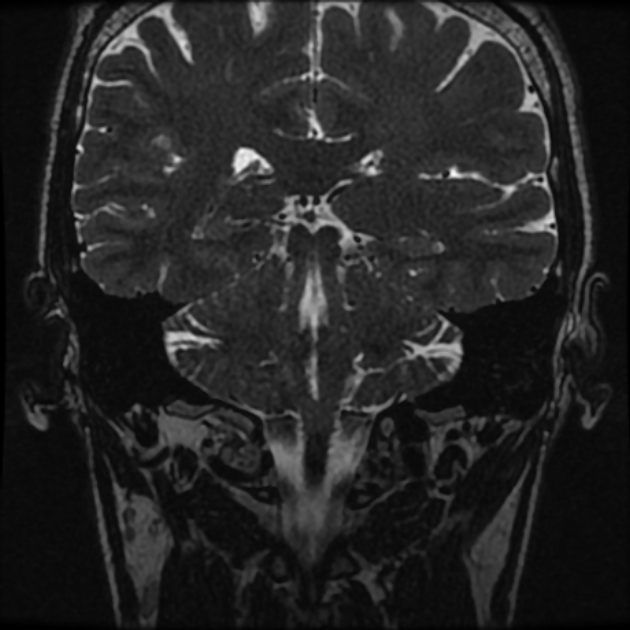 Normal MRI petrous (Radiopaedia 91317-108949 Coronal T2 76).jpg