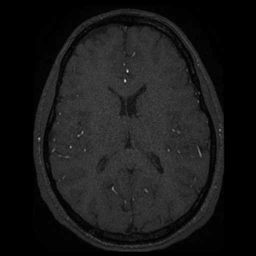 Normal brain MRA (Radiopaedia 41046-43793 Axial MRA 7).png