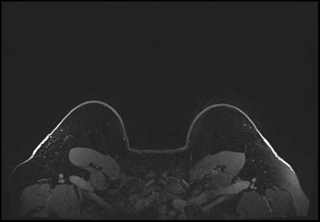 Normal breast MRI - dense breasts (Radiopaedia 80454-93850 C 217).jpg