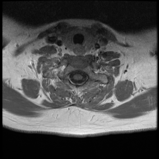 File:Normal cervical and thoracic spine MRI (Radiopaedia 35630-37156 Axial T1 C+ 9).png