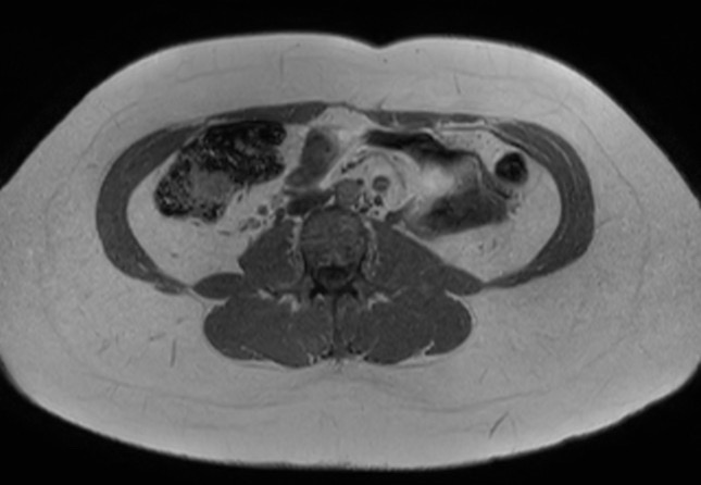 File:Normal liver MRI with Gadolinium (Radiopaedia 58913-66163 Axial T1 in-phase 2).jpg