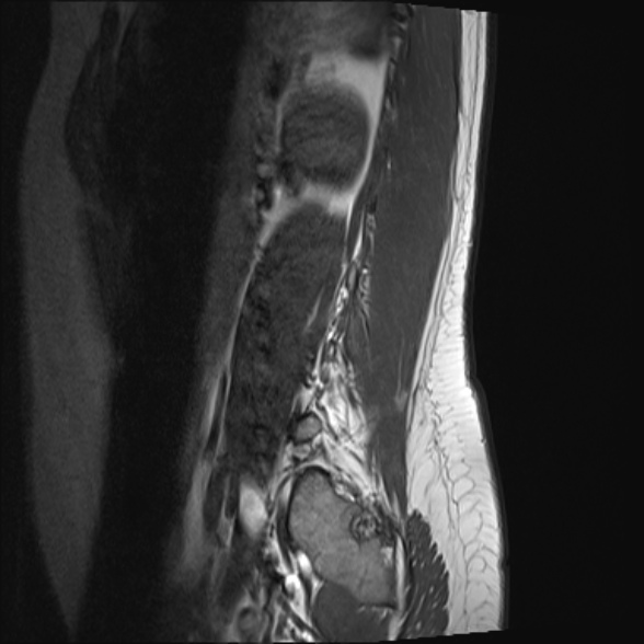File:Normal lumbar spine MRI- 3 T (Radiopaedia 53280-59250 Sagittal T1 22).jpg
