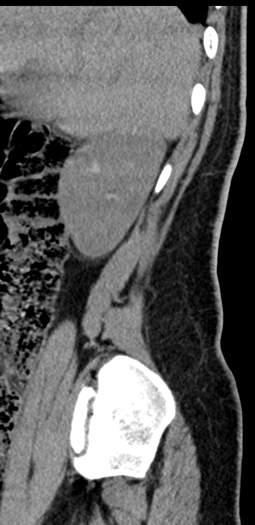 Normal lumbosacral CT (Radiopaedia 37923-39867 E 98).png