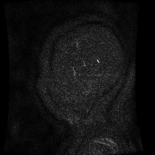 Normal noncontrast MR venography (Radiopaedia 87578-103957 A 170).jpg