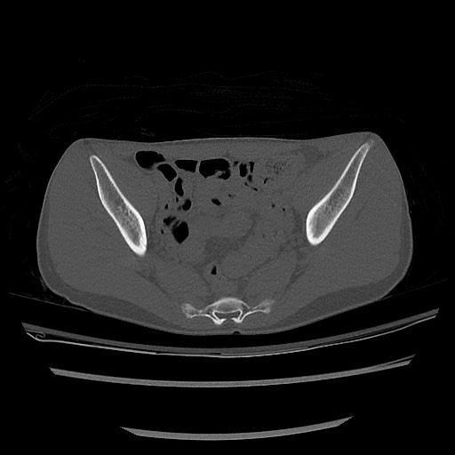 Normal pelvis CT (Radiopaedia 51471-57236 Axial bone window 49).jpg