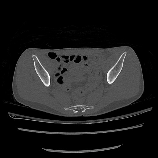 Normal pelvis CT (Radiopaedia 51471-57236 Axial bone window 51).jpg