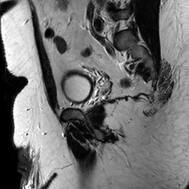 File:Normal prostate (MRI) (Radiopaedia 29986-30535 Sagittal T2 5).jpg
