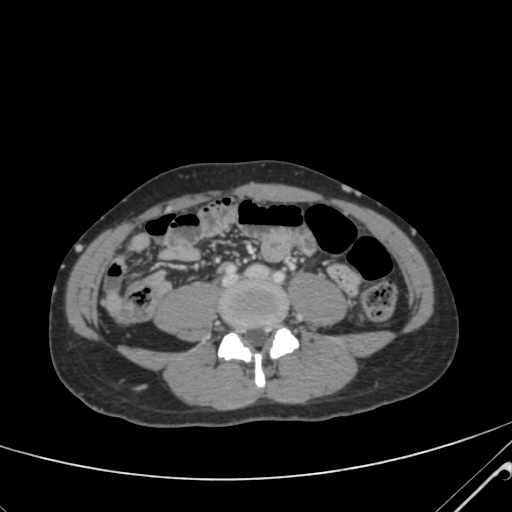 File:Nutmeg liver- Budd-Chiari syndrome (Radiopaedia 46234-50635 B 45).png
