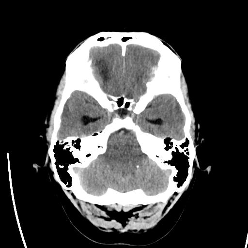 File:Obstructive hydrocephalus (Radiopaedia 30453-31119 Axial non-contrast 6).jpg