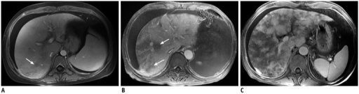 Post contrast-enhanced MR images show severity of patchy liver enhancement in hepatic sinusoidal obstruction syndrome.A. Grade 1. Arrow denotes mild patchy enhancement. B. Grade 2. Arrows denote moderate confluent patchy enhancement. C. Grade 3. Severe case with diffuse confluent patchy enhancement. Note all three cases demonstrate ascites.