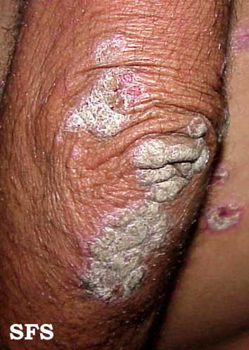 File:Psoriasis (Dermatology Atlas 18).jpg