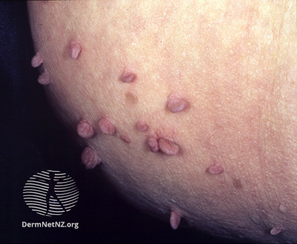 File:Skin tags (DermNet NZ lesions-tag1).jpg