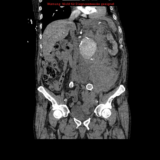 Abdominal aortic aneurysm- extremely large, ruptured (Radiopaedia 19882-19921 Coronal C+ arterial phase 51).jpg
