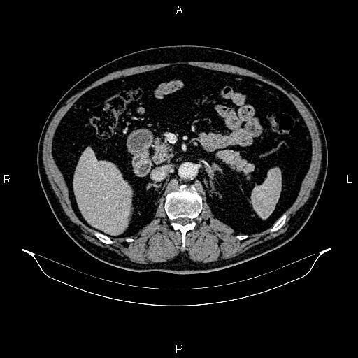 Abdominal aortic aneurysm (Radiopaedia 83094-97462 Axial renal cortical phase 87).jpg