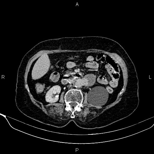 Abdominal aortic aneurysm (Radiopaedia 85063-100606 Axial C+ delayed 47).jpg