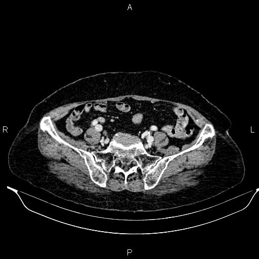 File:Abdominal aortic aneurysm (Radiopaedia 85063-100606 Axial C+ portal venous phase 54).jpg