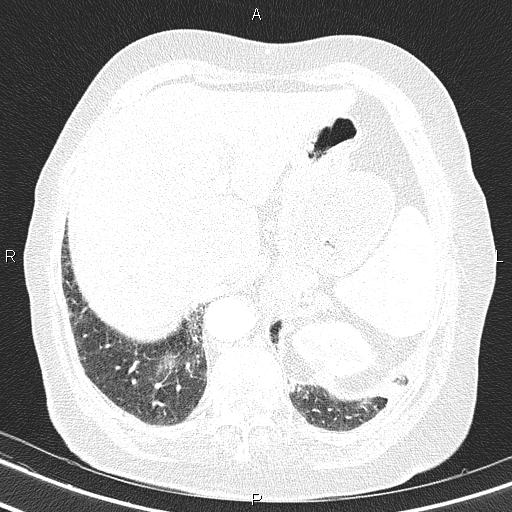 Abdominal aortic aneurysm (Radiopaedia 85063-100606 Axial lung window 58).jpg