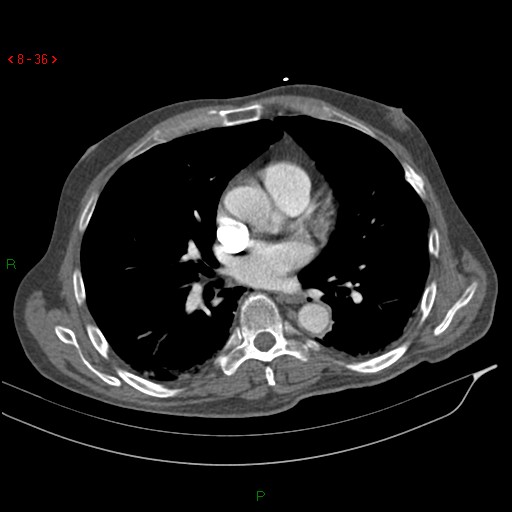 Abdominal aortic aneurysm rupture with aortocaval fistula (Radiopaedia 14897-14841 Axial C+ arterial phase 36).jpg