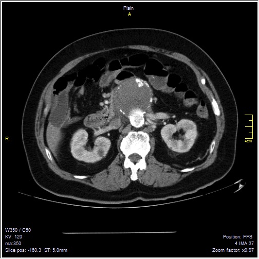 Abdominal aortic aneurysm with thrombus fissuration (Radiopaedia 47340-51926 Axial C+ arterial phase 21).jpg