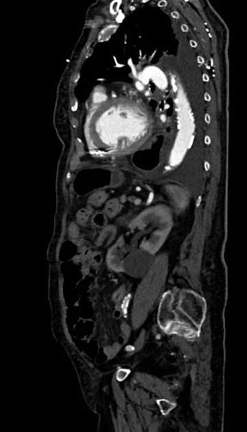 Abdominal aortic aneurysm with thrombus fissuration (Radiopaedia 73192-83919 Sagittal C+ arterial phase 42).jpg