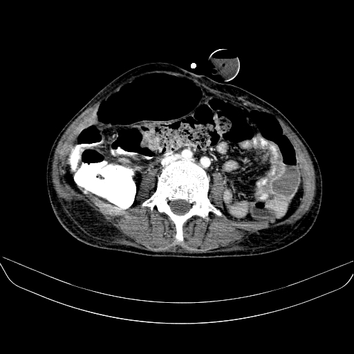 File:Abdominal collection due to previous cecal perforation (Radiopaedia 80831-94320 Axial C+ portal venous phase 118).jpg
