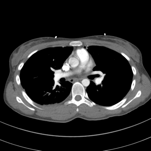 Abdominal multi-trauma - devascularised kidney and liver, spleen and pancreatic lacerations (Radiopaedia 34984-36486 Axial C+ arterial phase 40).png