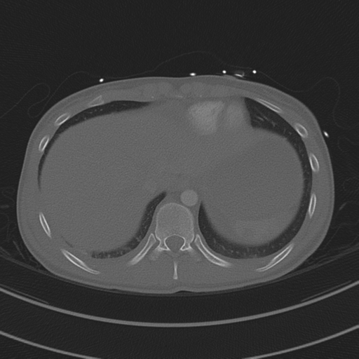 File:Abdominal multi-trauma - devascularised kidney and liver, spleen and pancreatic lacerations (Radiopaedia 34984-36486 I 71).png