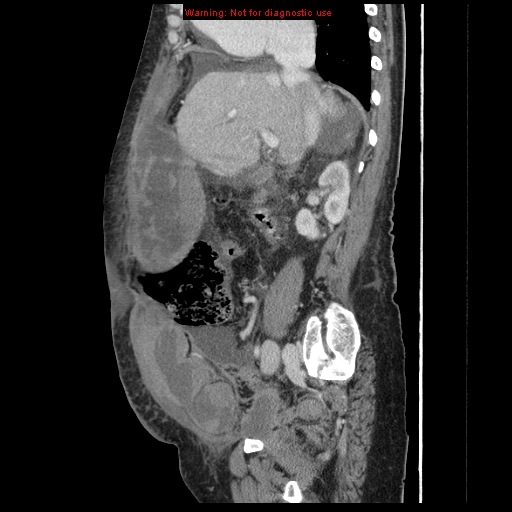 File:Abdominal wall hematoma (Radiopaedia 9427-10112 Sagittal C+ portal venous phase 68).jpg