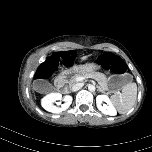 File:Abdominal wall hematoma with active bleeding (Radiopaedia 83915-99117 Axial C+ portal venous phase 10).jpg