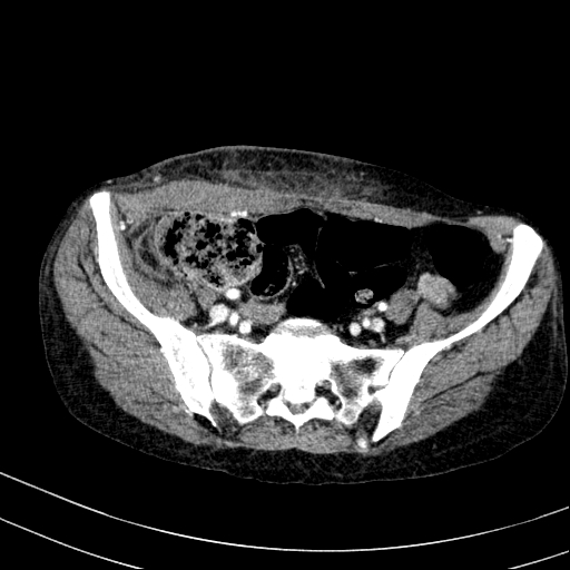 Abdominal wall hematoma with active bleeding (Radiopaedia 83915-99117 Axial renal cortical phase 101).jpg