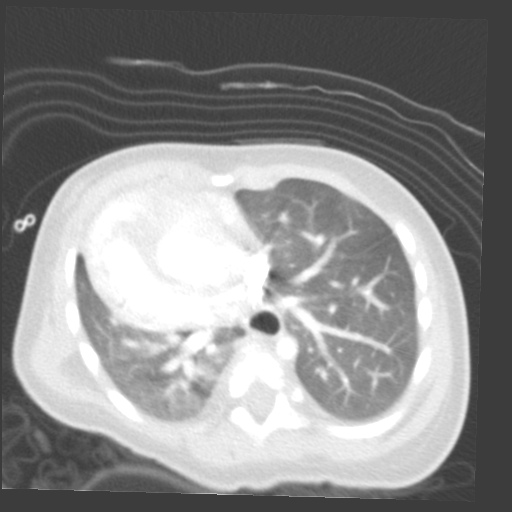 File:Aberrant left pulmonary artery (pulmonary sling) (Radiopaedia 42323-45435 Axial lung window 24).jpg
