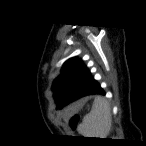 Aberrant left pulmonary artery (pulmonary sling) (Radiopaedia 42323-45435 Sagittal C+ arterial phase 50).jpg