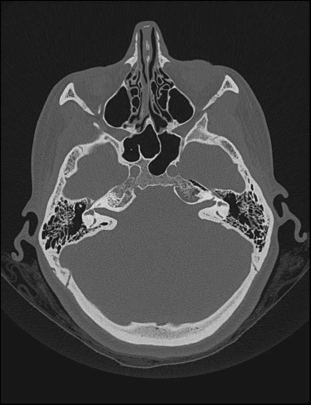 Aberrant right internal carotid artery (Radiopaedia 65191-74198 Axial non-contrast 48).jpg
