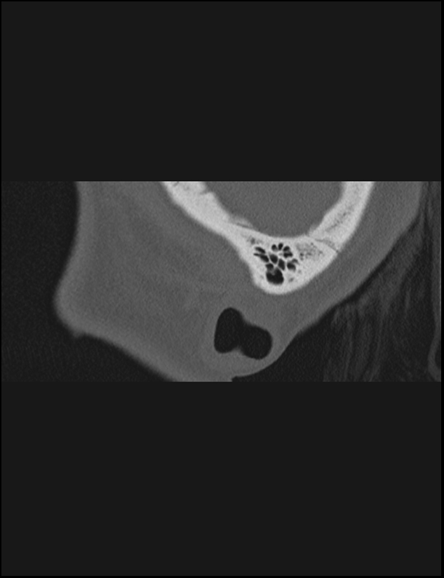 Aberrant right internal carotid artery (Radiopaedia 65191-74198 Sagittal non-contrast 8).jpg