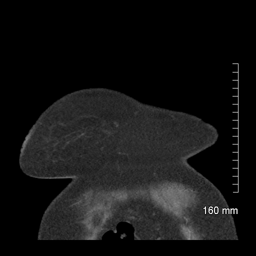 Aberrant right subclavian artery stenosis (Radiopaedia 52656-58670 B 9).jpg