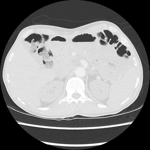 Accessory left horizontal fissure with lingular pneumonia (Radiopaedia 53763-59843 Axial lung window 57).jpg