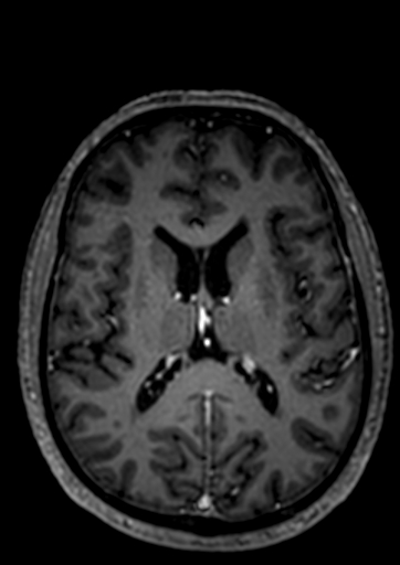Accessory middle cerebral artery (Radiopaedia 73114-83828 Axial T1 C+ 9).jpg